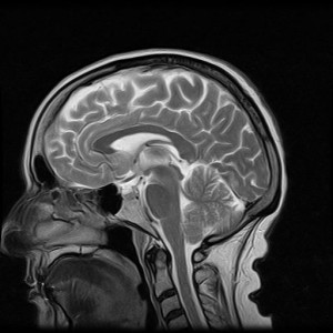 MR Brain
